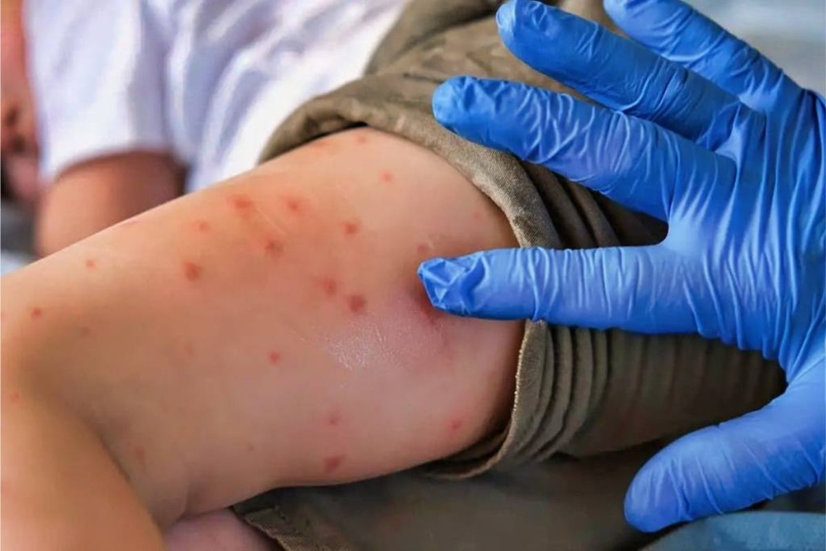 Vacunación contra el sarampión en municipios de Veracruz con casos confirmados